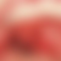 Syphilis: Angina specifica in early syphilis and simultaneous HIV infection; bright red, largely ...
