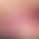 Syphilis acquisita: two sharply defined, surprisingly coarse, completely indolent, red, yellowish...