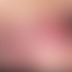 Syphilis acquisita: zwei seit 14 Tagen bestehende, scharf begrenzte, überaschend derbe, komplett ...
