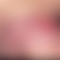 Syphilis acquisita: zwei seit 14 Tagen bestehende, scharf begrenzte, überaschend derbe, komplett ...