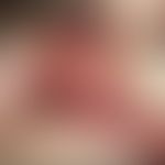 Syphilis acquisita:&nbsp;schmerzloser, sehr derber Primäraffekt der Oberlippe, 3 Wochen nach susp...