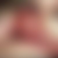 Syphilis acquisita:&nbsp;schmerzloser, sehr derber Primäraffekt der Oberlippe, 3 Wochen nach susp...