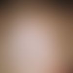 Syphilis acquisita. Alopecia specifica diffusa. Kleinherdiger, nicht entzündlicher Haarausfall, t...