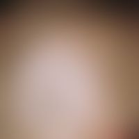 Syphilis acquisita. alopecia specifica diffusa. small hearth, non-inflammatory hair loss, partly ...