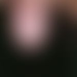 Syphilis acquisita. Papulöses Syphilid: Bei dem 42-jährigen, HIV-positiven Mann bestehen erythema...
