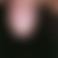 Syphilis acquisita. Papulöses Syphilid: Bei dem 42-jährigen, HIV-positiven Mann bestehen erythema...