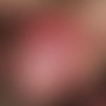 Syphilis acquisita:&nbsp;solitäres, akutes, 0,4 x 0,9 cm großes, indolentes, derbes Ulkus bei ein...