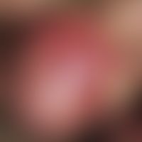 Syphilis acquisita:&nbsp;solitäres, akutes, 0,4 x 0,9 cm großes, indolentes, derbes Ulkus bei ein...