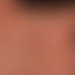 Syphilis acquisita:&nbsp;makulo-papulöses Exanthem, psoriasiformes Palmarsyphilid bei HIV-Infekti...