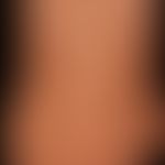Syphilis Frühsyphilis: papulöses, stellenweise psoriasiform schuppendes,&nbsp;chronisches Exanthe...