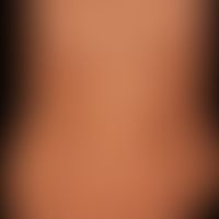 Syphilis Early syphilis: papular , in places psoriasiform scaling, chronic exanthema. Fading eryt...