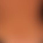 Syphilis acquisita:&nbsp;makulo-papulöses stellenweise psoriasiformes Exanthem.
