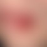 Syphilis Frühsyphilis: seit 1 Woche bestehender Primäraffekt an der Unterlippe.
