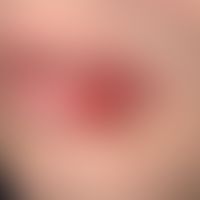Syphilis Early syphilis: primary effect on the lower lip existing since 1 week.
