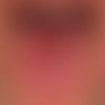 Plaques muqueuses bei einem gleichzeitig vorhandenen, makulo-papulösen syphilitischen Exanthem. C...