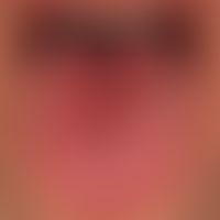 Plaques muqueuses in the presence of a maculo-papular syphilitic exanthema; characteristic, large...