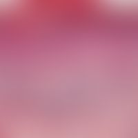 lupus erythematosus, systemic. skin changes induced by sunlight irradiation. slightly atrophic su...