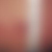 Syringocystadenoma papilliferum, a solitary reddish-brown hemispherical tumor on the forehead in ...