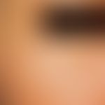 Syringoma: up to pinhead-sized, isolated and aggregated, symptom-free, firm papules in the area o...