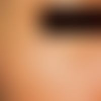 Syringoma: up to pinhead-sized, isolated and aggregated, symptom-free, firm papules in the area o...