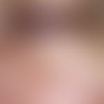 Syringoma. 30-year-old female patient has small, up to pinhead-sized, isolated and aggregated, sy...