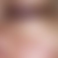 Syringoma. 30-year-old female patient has small, up to pinhead-sized, isolated and aggregated, sy...
