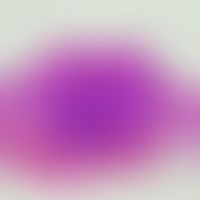 Talgdrüsenepitheliom: gut abgegrenzter, solider, basaloider Geschwulstknoten in der oberen und mi...