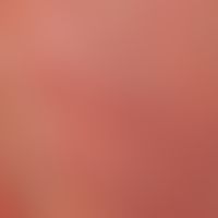 Sebaceous gland hyperplasia, senile. skin-coloured irritationless papules with central porus in t...
