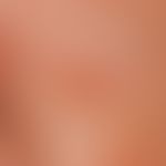 Sebaceous gland hyperplasia, senile. 0.5 cm large, yellowish-brownish, surface indented, shiny pa...