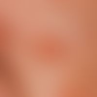 Sebaceous gland hyperplasia, senile. 0.5 cm large, yellowish-brownish, surface indented, shiny pa...