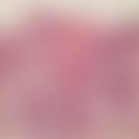 Sebaceous gland hyperplasia, senile. numerous mature sebaceous gland lobules around an ectatic, h...