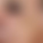 sebaceous gland hyperplasia, senile. large, isolated, skin-coloured to yellowish, soft-elastic no...