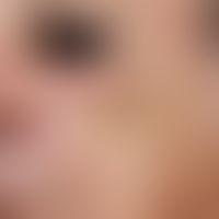 sebaceous gland hyperplasia, senile. large, isolated, skin-coloured to yellowish, soft-elastic no...