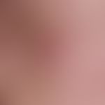 Sebaceous gland hyperplasia, senile. chronic stationary, on the cheek localized, blurred, soft, s...