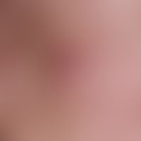 Sebaceous gland hyperplasia, senile. chronic stationary, on the cheek localized, blurred, soft, s...