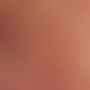 Tapeziernagelphänomen. Auflichtmikroskopie (ohne Kontaktmedium): Kegelförmige, teilweise aus dem ...