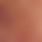 Wallpaper nail phenomenon: incident light microscopy (without contact medium): cone-shaped kerati...