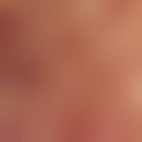 Tapeziernagelphänomen. Auflichtmikroskopie (ohne Kontaktmedium): Kegelförmige, teilweise aus dem ...