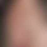 Teleangiectasia hereditaria haemorrhagica. Multiple, chronisch stationäre, seit 10 Jahren unmerkl...
