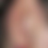 Teleangiectasia hereditaria haemorrhagica. Multiple, chronisch stationäre, seit 10 Jahren unmerkl...