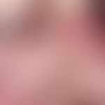 Teleangiectasia hereditaria haemorrhagica. Bei der 40-jährigen Patientin bestehen blaurote bis du...