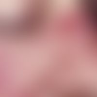 Teleangiectasia hereditaria haemorrhagica. Bei der 40-jährigen Patientin bestehen blaurote bis du...