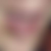 Teleangiectasia hereditaria haemorrhagica. Multiple, chronisch stationäre, seit Jahren unmerklich...