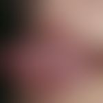 Teleangiectasia hereditaria haemorrhagica. Solitärer, chronisch stationärer, am lateralen Zungenr...