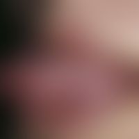 Teleangiectasia hereditaria haemorrhagica. Solitärer, chronisch stationärer, am lateralen Zungenr...