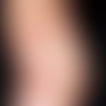 Teleangiectasia macularis eruptiva perstans. 53-jähriger Patient mit seit Jahren bestehendem exan...