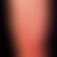 Teleangiectasia macularis eruptiva perstans. patient as before. proximally reticular erythema of ...