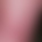 Teleangiektasie: dichte Netze von Gefäßerweiterungen, distal scharfe Aussparung.
