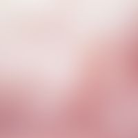 Teleangiektasie-Syndrom, naevoides. Auflichtmikroskopie: Feine, netzförmig verzweigte Kapillarekt...