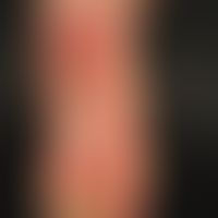 Thomson's syndrome: Massive, chronically stationary hyperkeratosis on the right sole of the foot,...